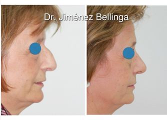 Antes y después Rinoplastia reducción