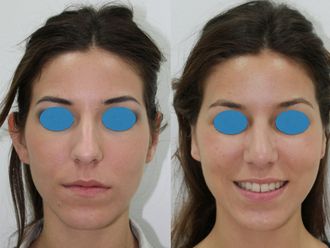 Otoplastia - 464850