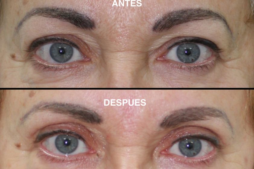Blefaroplastia antes y después - 464851