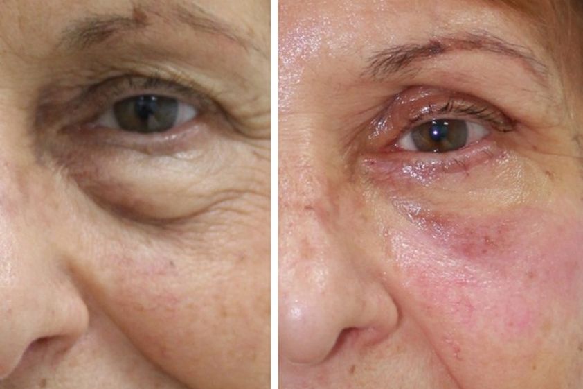 Peeling antes y después - 489604