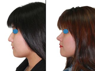 Antes y después rinoplastia - Dr. Jiménez Bellinga