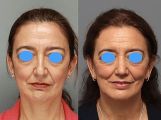 Rinoplastia