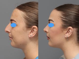 Rinoplastia ultrasónica