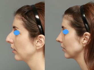 Rinoplastia antes y después - 878452
