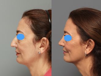Rinoplastia antes y después - 878453