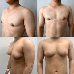 Cirugía transgénero, masculinización - Tintoré & Brasó