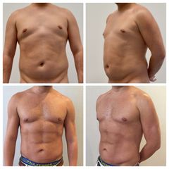 Lipofit4D con tecnología Vaser Lipo - Tintoré & Brasó