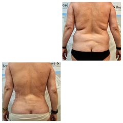 Lipofit4D con tecnología Vaser Lipo - Tintoré & Brasó