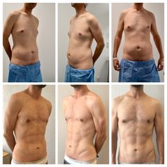 Lipofit4D con tecnología Vaser Lipo - Tintoré & Brasó