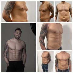 Lipofit4D con tecnología Vaser Lipo - Tintoré & Brasó
