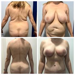 Lipofit4D con tecnología Vaser Lipo - Tintoré & Brasó