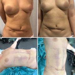 Abdominoplastia y cirugía constructiva - Tintoré & Brasó