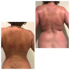 Lipofit4D, espalda y cintura - Tintoré & Brasó