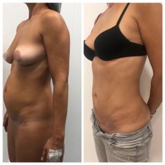 Abdominoplastia - Tintoré & Brasó