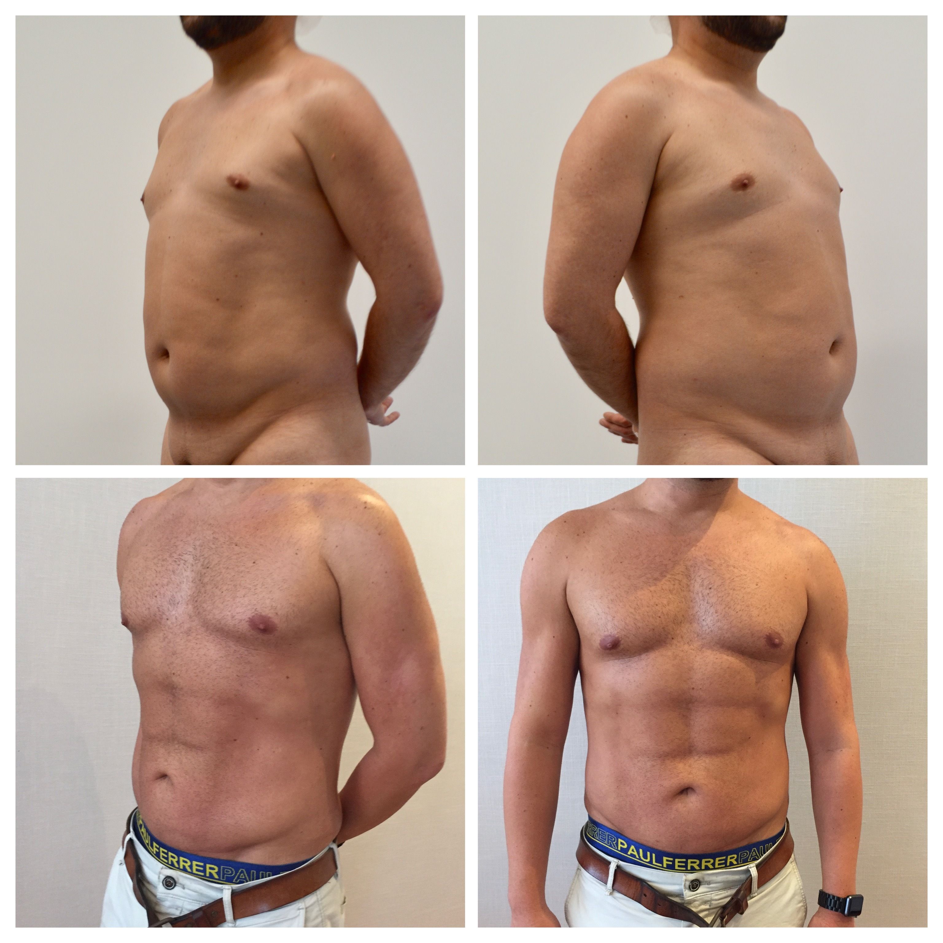 Coolsculpting before and after Pic in NYC