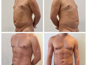 Liposucción - 740635