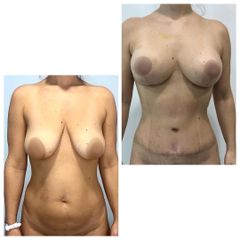 Abdominoplastia + Mastopexia - Tintoré & Brasó