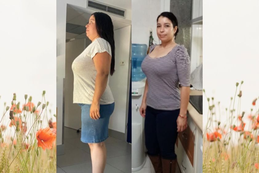 Tratamiento obesidad antes y después - 739723