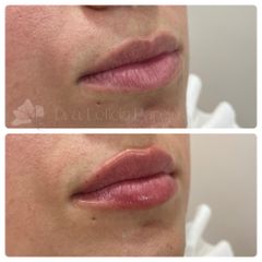 Aumento de labios - Dra. Leticia Parejo García