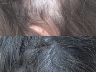 Alopecia antes y después - 861580