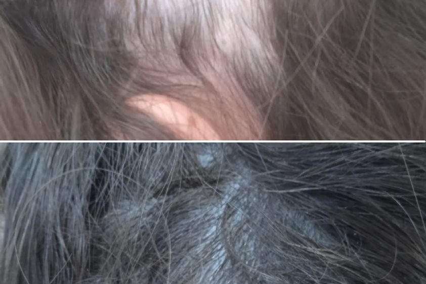 Alopecia antes y después - 861580