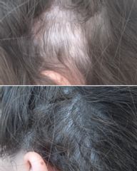 Alopecia - dh belleza