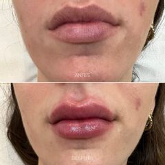 Aumento de labios - dh belleza