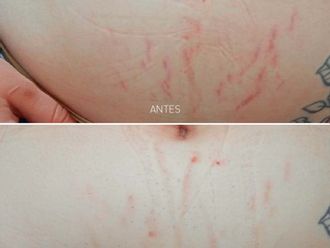 Eliminación de estrías antes y después - 861582