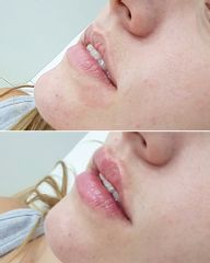 Aumento labios - dh belleza