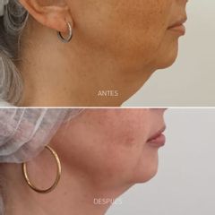 Hilos tensores - dh belleza