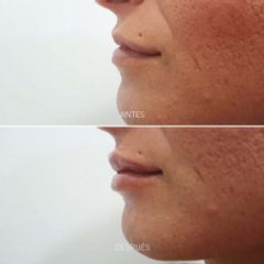 Aumento labios - dh belleza
