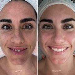 Tratamiento antimanchas - dh belleza