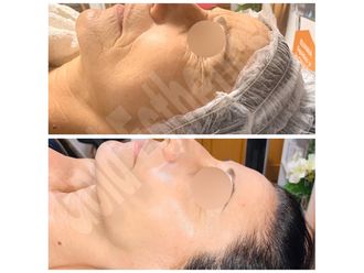 Carboxiterapia - 649738