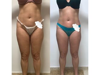 Celulitis - 649741