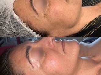 Radiofrecuencia facial - 788367