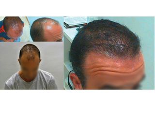 Antes y después Trasplante de pelo