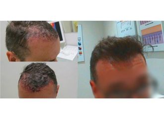 Alopecia - 648387