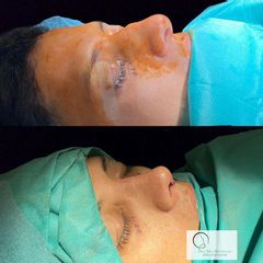 Rinoplastia Ultrasónica - Dra. Susan Díaz