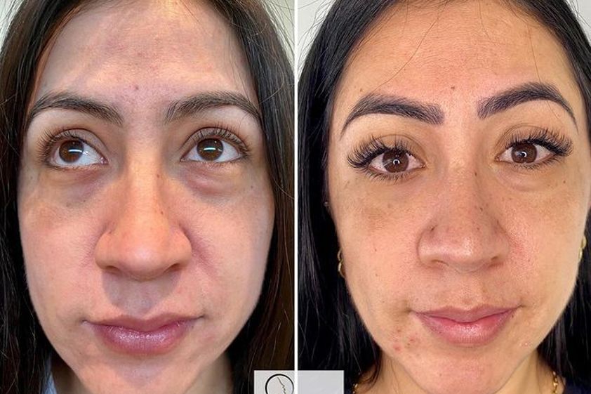 Eliminación ojeras antes y después - 799580