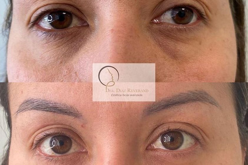 Eliminación ojeras antes y después - 799584