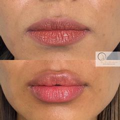 Aumento de labios - Dra. Susan Díaz