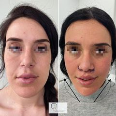 Minilifting Facial - Dra. Susan Díaz