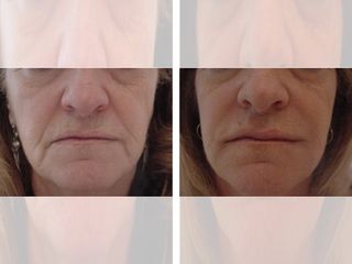 Antes y después rellenos faciales Rictus y comisura labial
