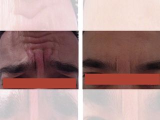 Antes y después bótox - Arrugas del entrecejo