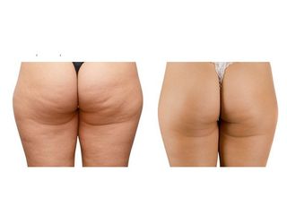 Antes y después Mesoterapia