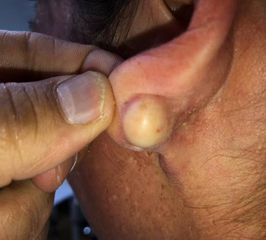  Dr Carlos López - lipoma