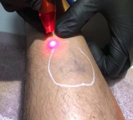  Dr Carlos López - Laser vascular