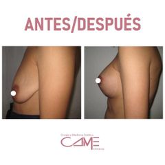 Elevación de pecho - Clínicas Came
