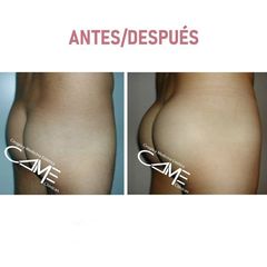 Aumento de glúteos - Clínicas Came