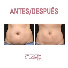 Liposucción - Clínicas Came